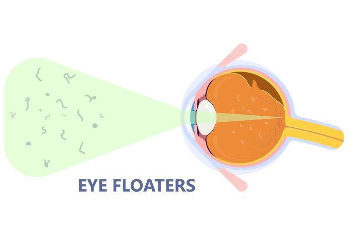 Eye Floaters Overview: Explore Basics, Causes, Facts, and Helpful Information